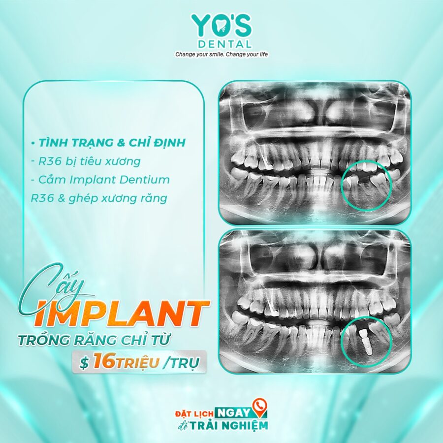 Cấy ghép Implant Nha Khoa Sài Gòn Đắk Nông