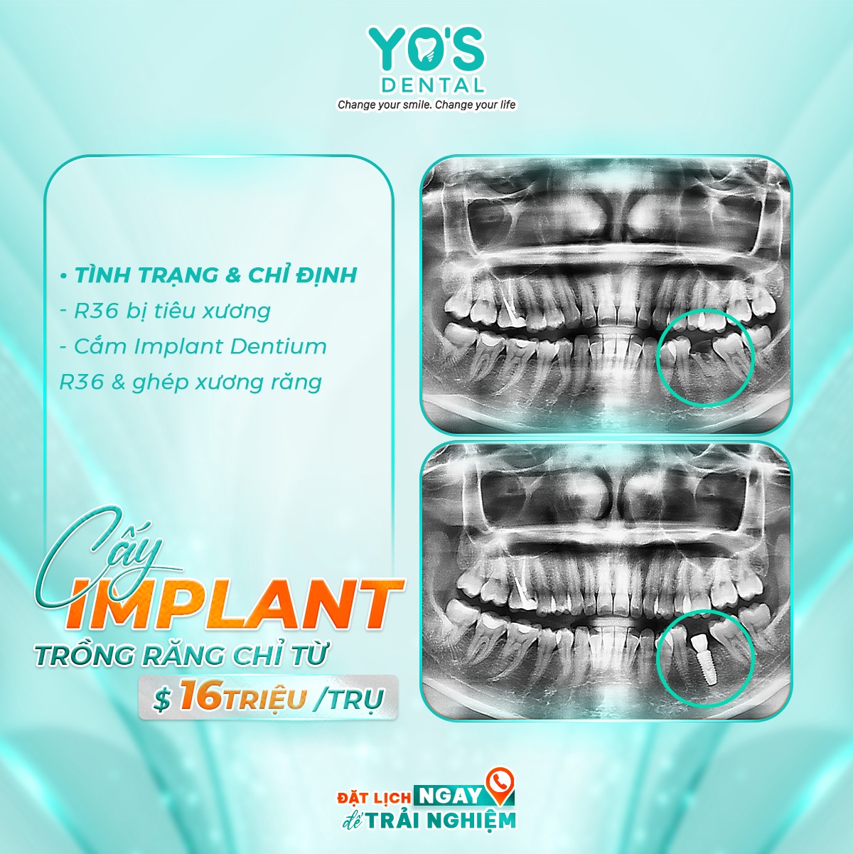 Cấy ghép Implant Nha Khoa Sài Gòn Đắk Nông