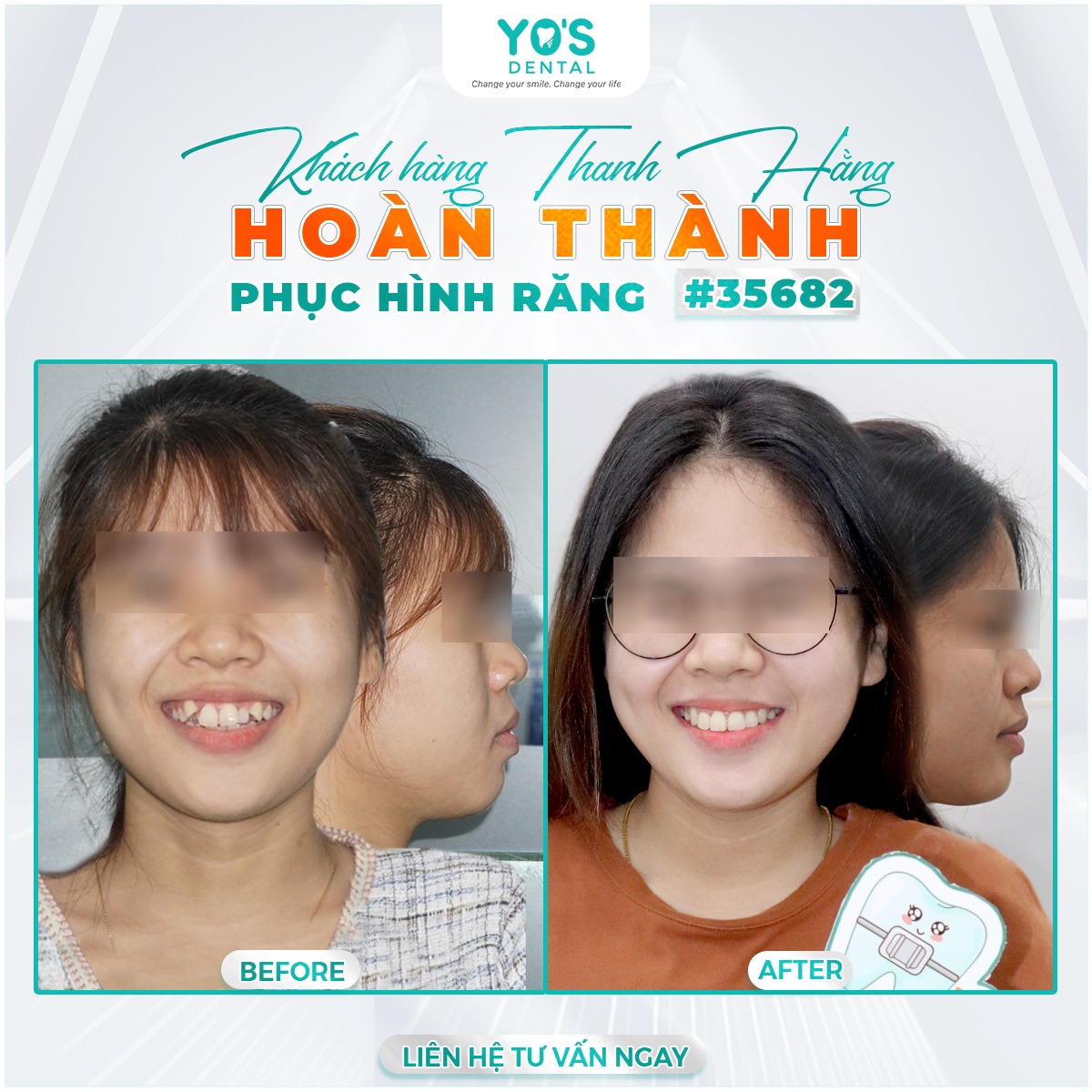 Khách hàng Thanh Hằng hoàn thành phục hình răng