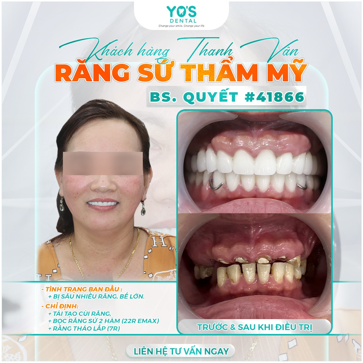 Khách hàng Thanh Vân răng sứ thẩm mỹ