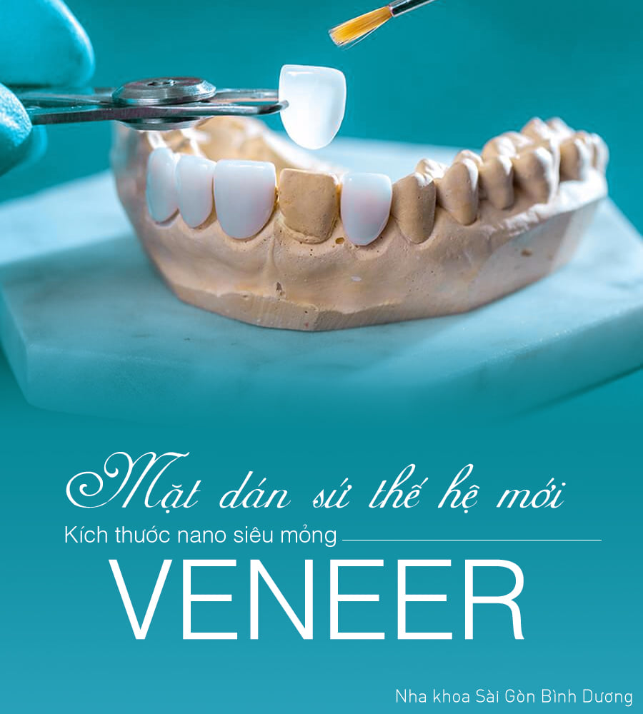 MẶT DÁN SỨ VENNEER