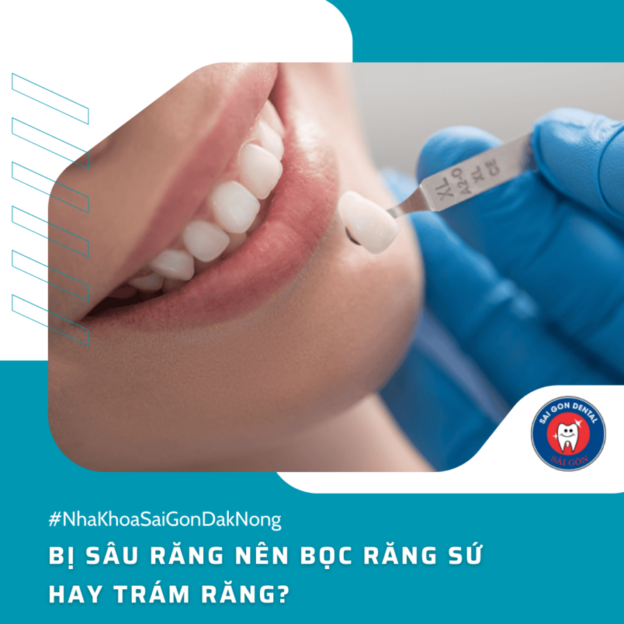 Bị sâu răng nên bọc răng sứ hay trám răng?
