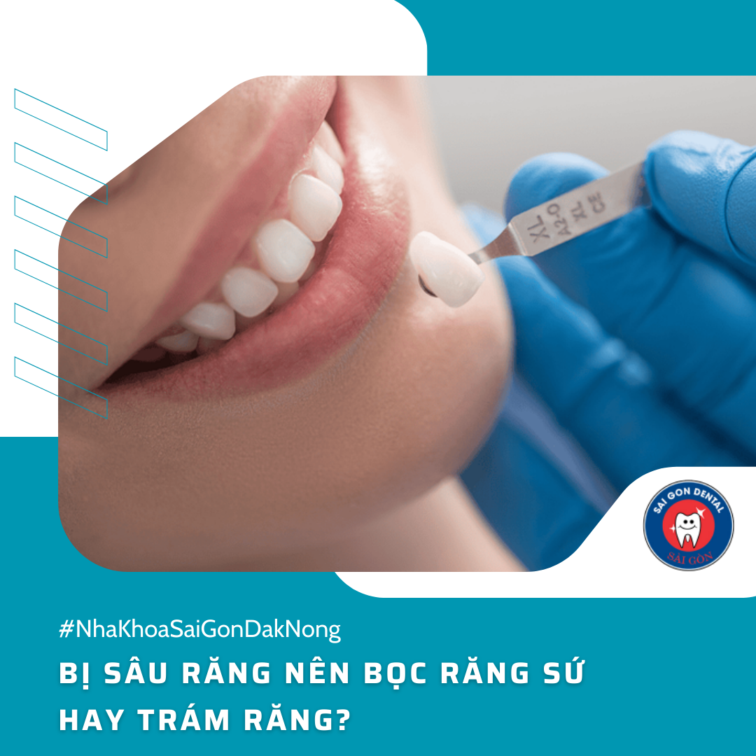 Bị sâu răng nên bọc răng sứ hay trám răng?
