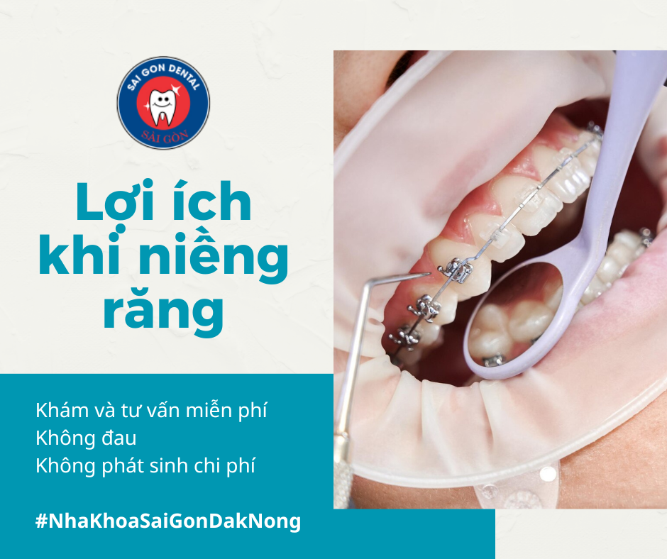 Niềng răng là gì? Lợi ích khi niềng răng