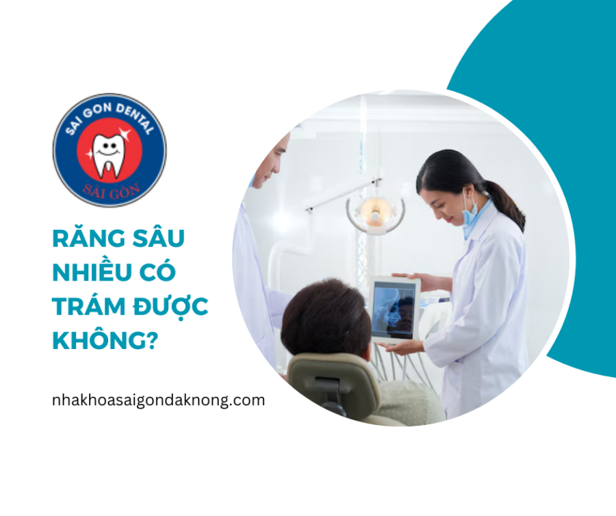 Răng sâu nhiều có trám được không?