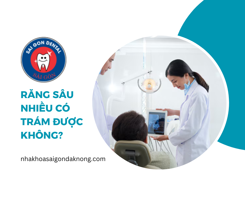 Răng sâu nhiều có trám được không?