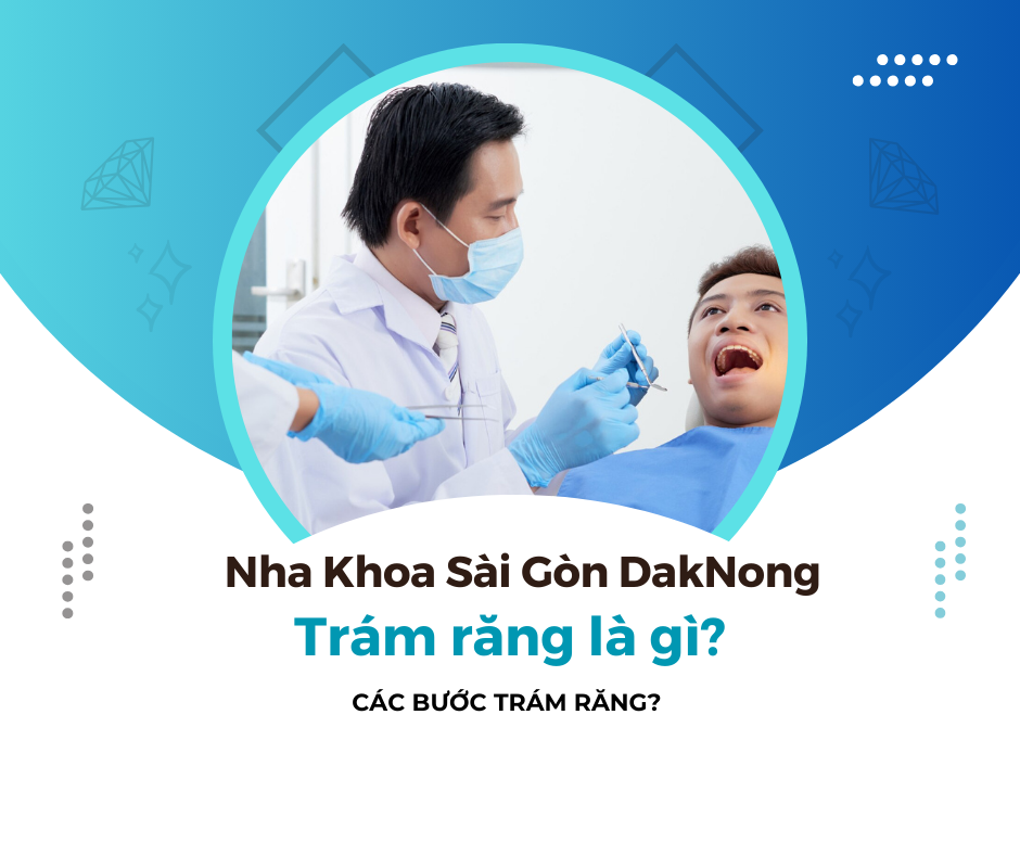 Trám răng là gì? Các bước trám răng